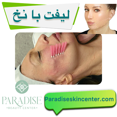 لیفت با نخ