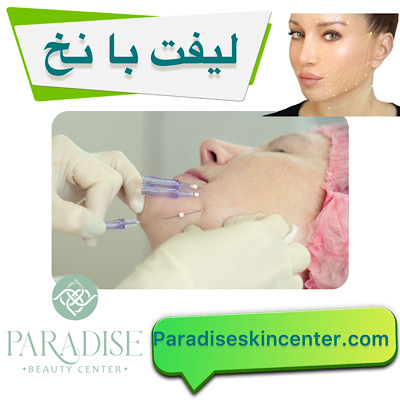 لیفت با نخ