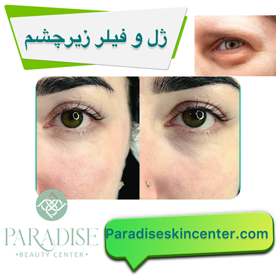 ژل و فیلر زیر چشم