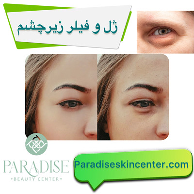 ژل و فیلر زیر چشم