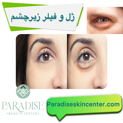 ژل و فیلر زیر چشم