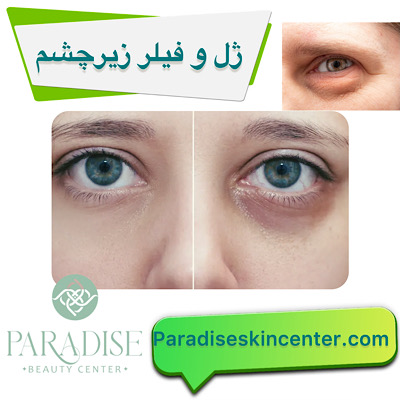 ژل و فیلر زیر چشم