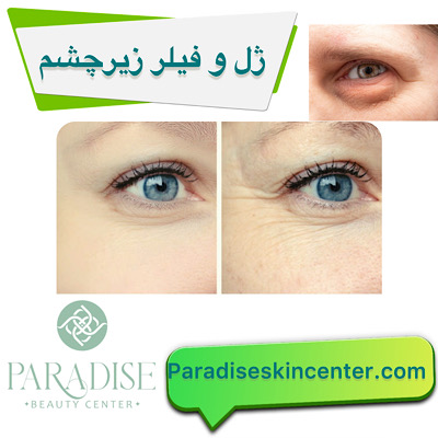 ژل و فیلر زیر چشم