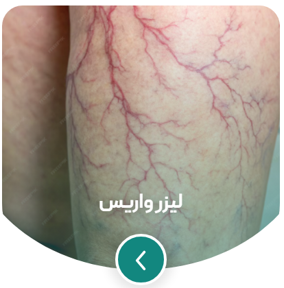 لیزر واریس