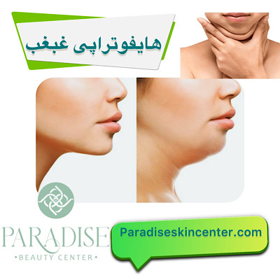هایفوتراپی در ناحیه غبغب