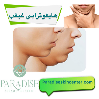 هایفوتراپی در ناحیه غبغب