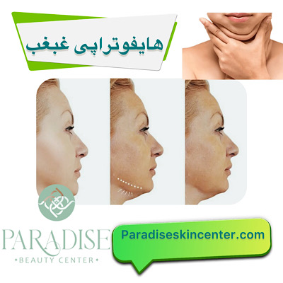 هایفوتراپی در ناحیه غبغب