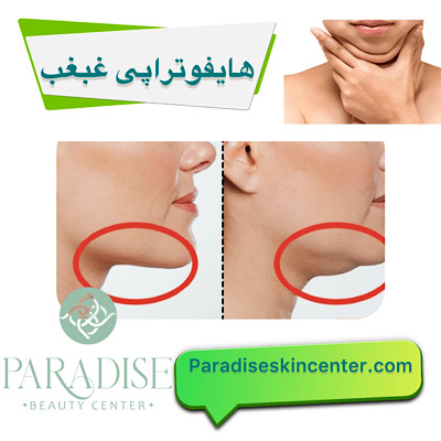 هایفوتراپی در ناحیه غبغب