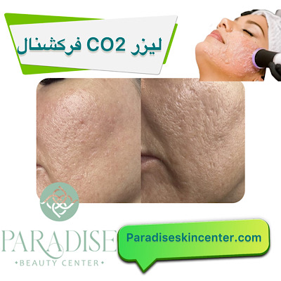 لیزر CO2 فرکشنال