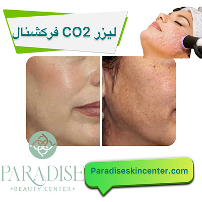 لیزر CO2 فرکشنال