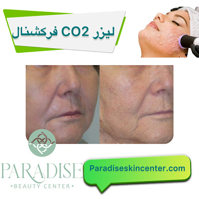 لیزر CO2 فرکشنال