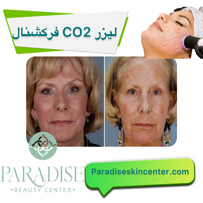 لیزر CO2 فرکشنال