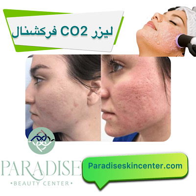 لیزر CO2 فرکشنال