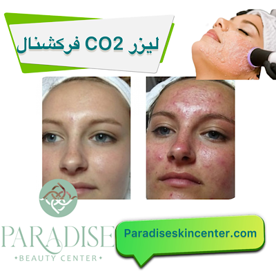 لیزر CO2 فرکشنال
