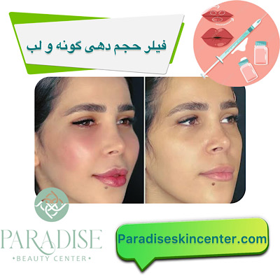 فیلر حجم‌دهی گونه و لب