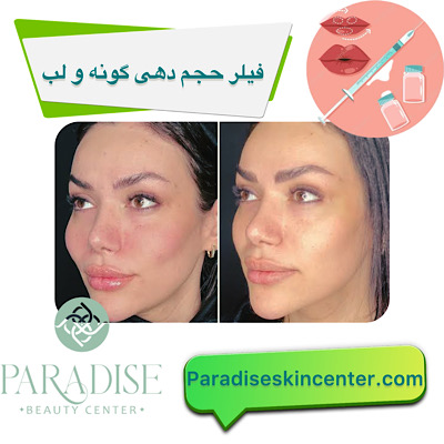 فیلر حجم‌دهی گونه و لب