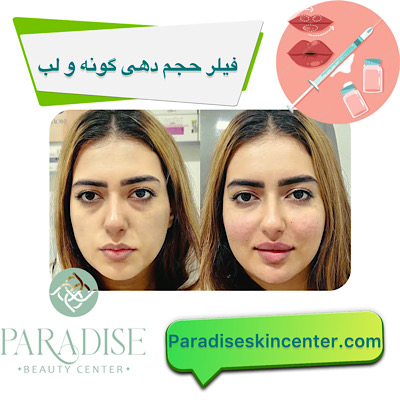 فیلر حجم‌دهی گونه و لب