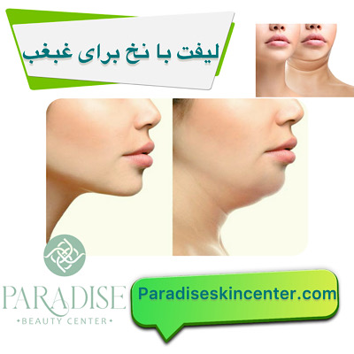 لیفت با نخ برای غبغب