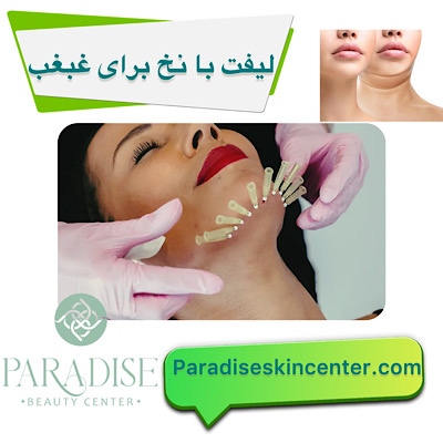 لیفت با نخ برای غبغب