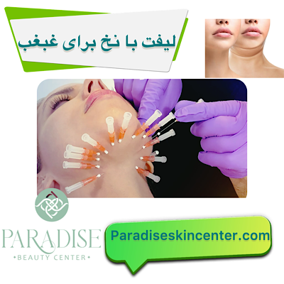 لیفت با نخ برای غبغب