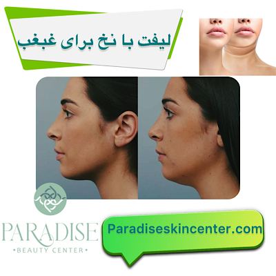 لیفت با نخ برای غبغب