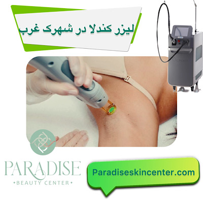 لیزر کندلا در شهرک غرب