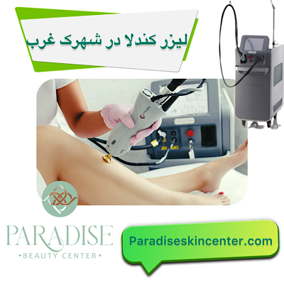 لیزر کندلا در شهرک غرب