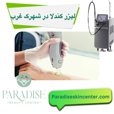 لیزر کندلا در شهرک غرب