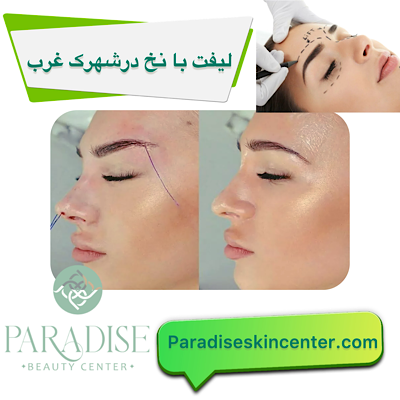  لیفت با نخ در شهرک غرب