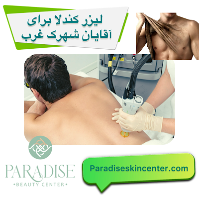 لیزر کندلا برای آقایان در شهرک غرب تهران