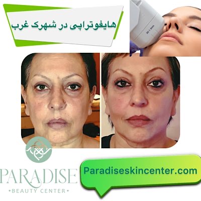 هایفوتراپی در شهرک غرب