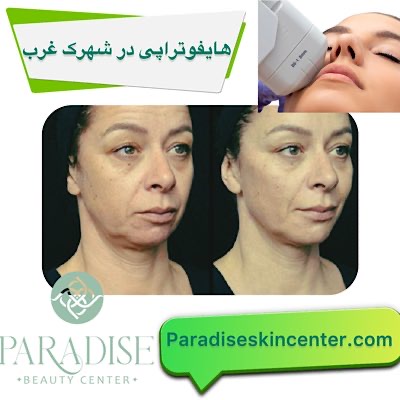 هایفوتراپی در شهرک غرب