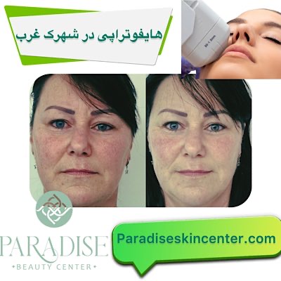 هایفوتراپی در شهرک غرب