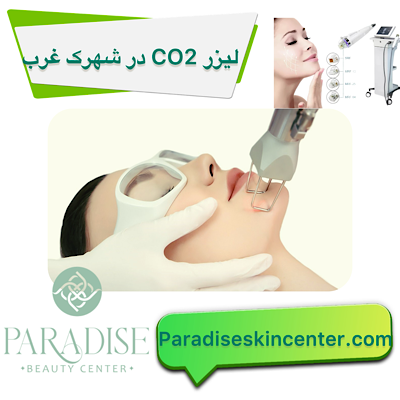 لیزر CO2 در شهرک غرب