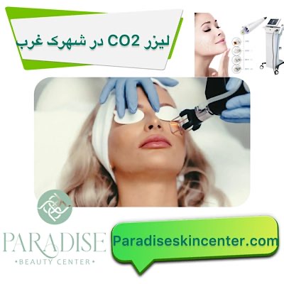 لیزر CO2 در شهرک غرب