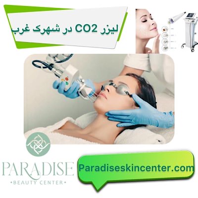لیزر CO2 در شهرک غرب