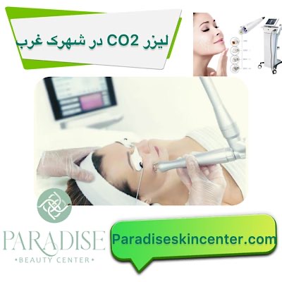 لیزر CO2 در شهرک غرب