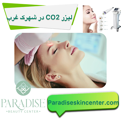 لیزر CO2 در شهرک غرب