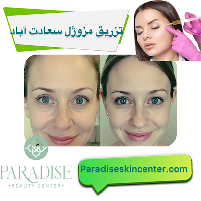 تزریق مزوژل سعادت اباد