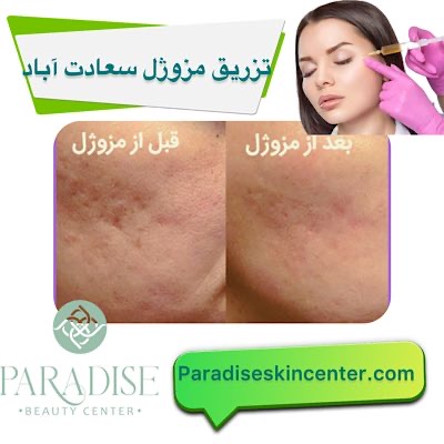 تزریق مزوژل سعادت اباد