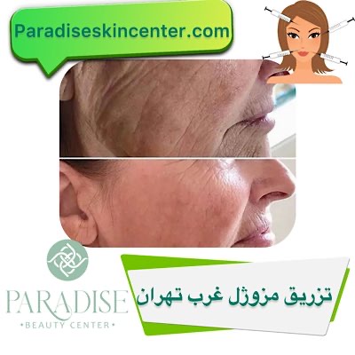 تزریق مزوژل غرب تهران