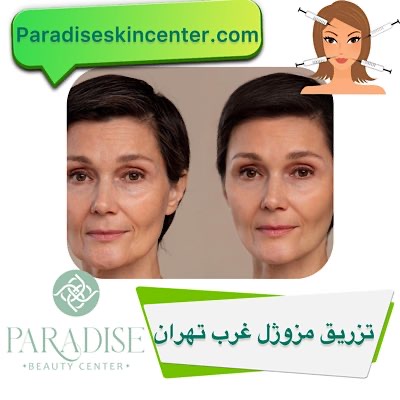 تزریق مزوژل غرب تهران
