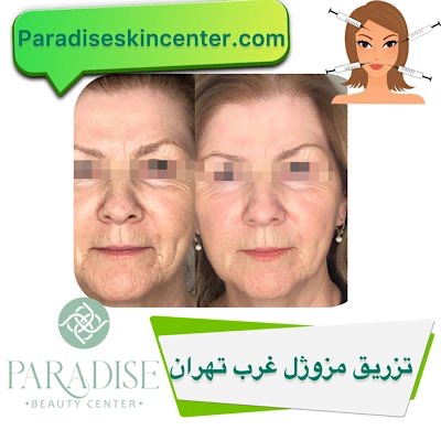 تزریق مزوژل غرب تهران