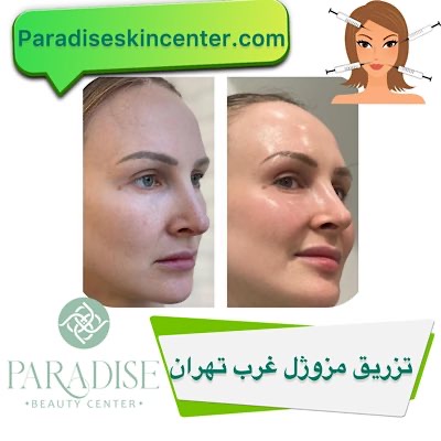 تزریق مزوژل غرب تهران