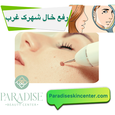 رفع خال در شهرک غرب
