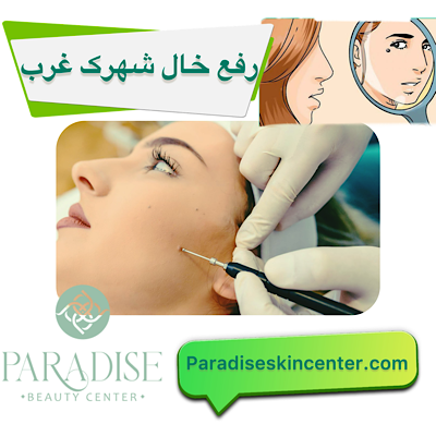 رفع خال در شهرک غرب