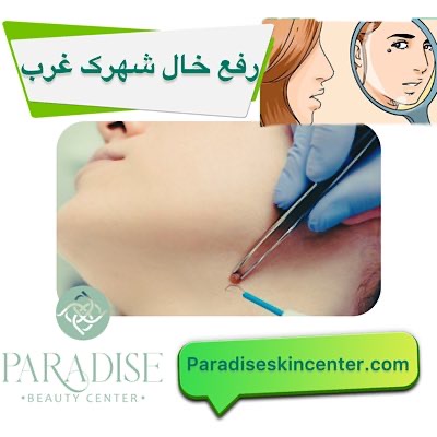 رفع خال در شهرک غرب