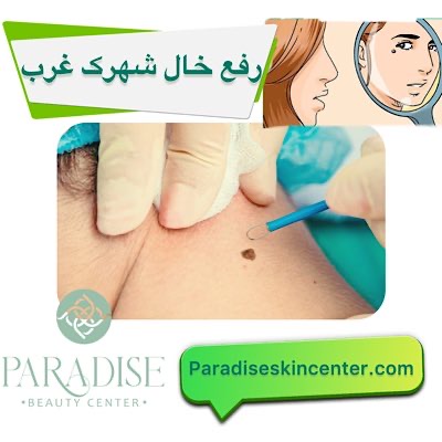 رفع خال در شهرک غرب