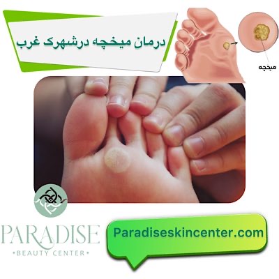 درمان میخچه در شهرک غرب