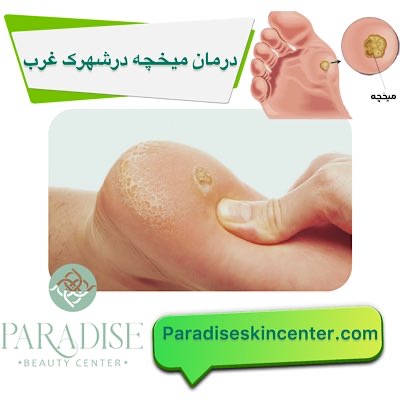 درمان میخچه در شهرک غرب